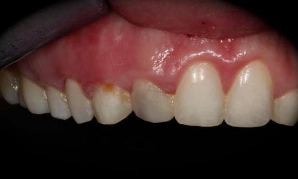 Composite-Bonding-Before-Image