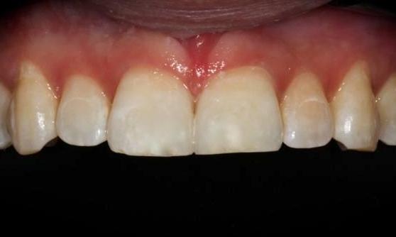 Composite-Bonding-After-Image