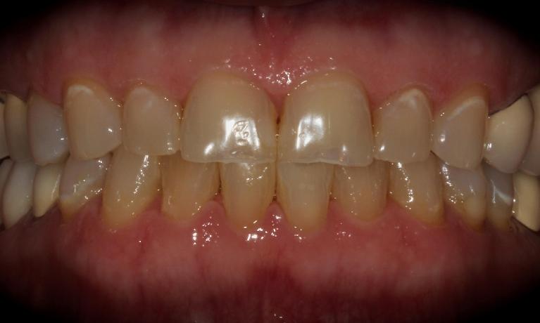 KoR-Whitening-Before-Image