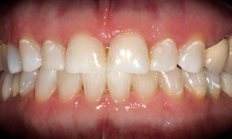 KoR-Whitening-After-Image