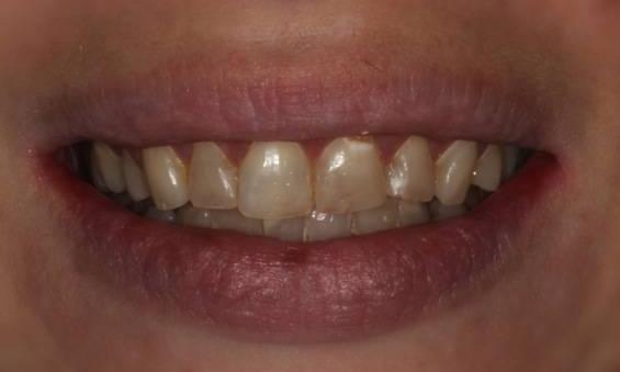 Porcelain-Crowns-Before-Image