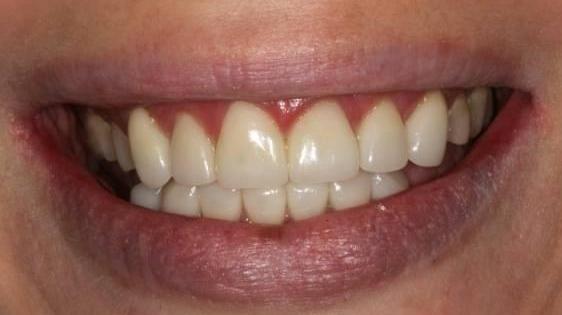 Porcelain-Crowns-After-Image